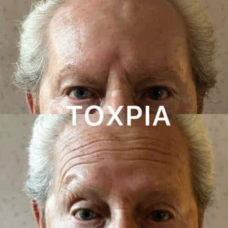 Resultados Toxpia 3 - GS